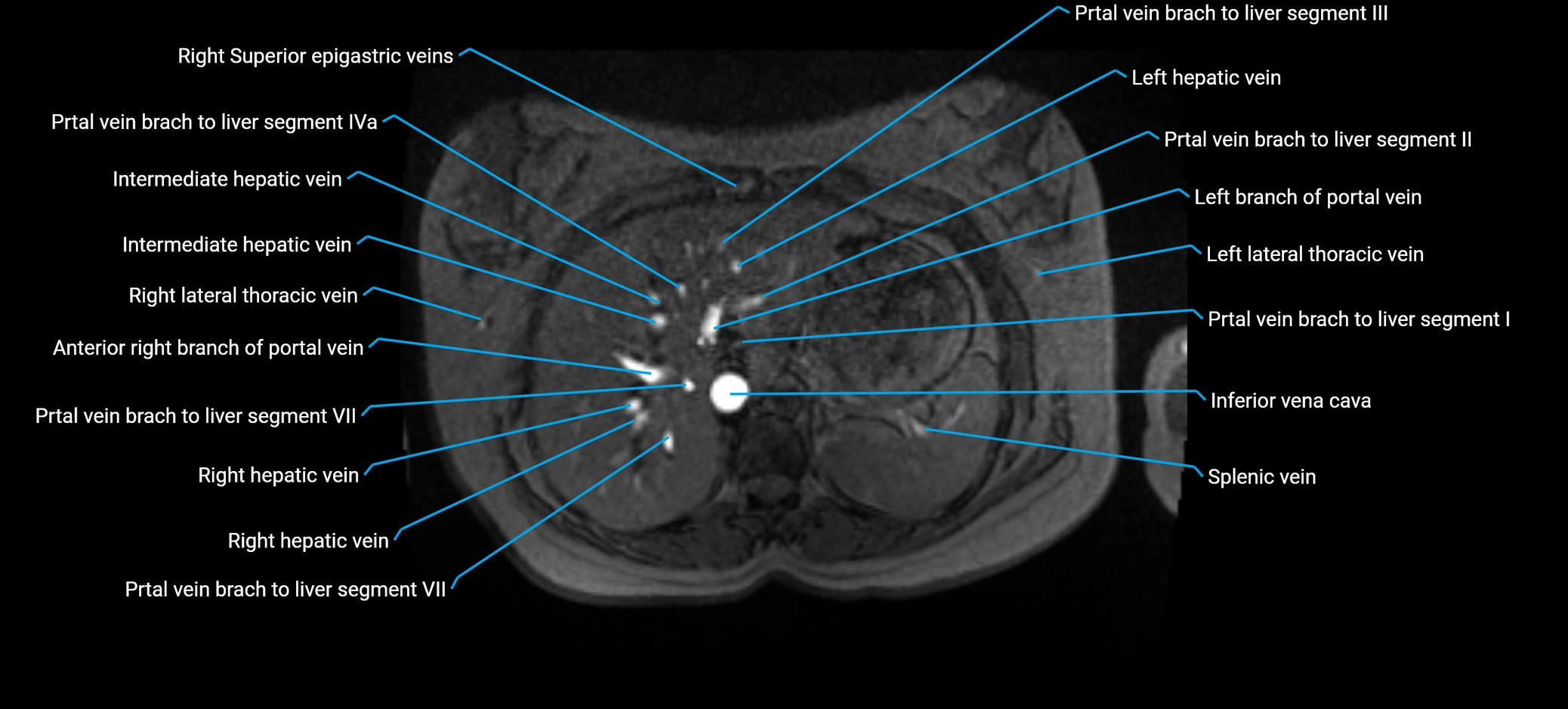 MRV abdomen pelvis & lower limb axial cross sectional anatomy labelled MRI image 34 (1).webp
